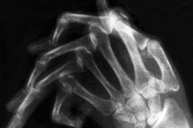 SLE  X-ray (AP) with severe MP joint subluxations and dislocations without joint erosions.  Note the boutonniere deformity in index finger.