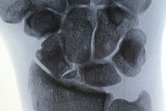 Scaphoid nonunion with early arthritis at radioscaphoid joint (non-stress view).