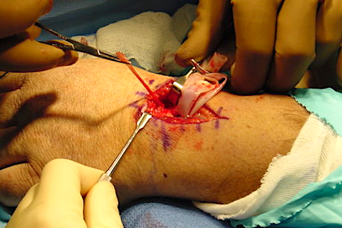 Harvesting half of the ECRL tendon for a fascial arthroplasty after distal scaphoid excision.