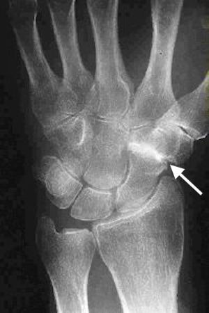 STT Osteoarthritis left wrist (arrow)