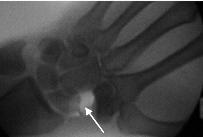 STT Osteoarthritis left wrist after excision of the distal pole of the scaphoid. (arrow)