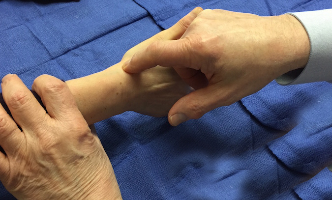 Patients with STT arthritis will have tenderness in the anatomic snuff box without a history of wrist trauma.