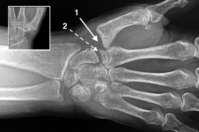 Combined STT & Thumb CMC OA (insert). This can reliably be treated by trapeziectomy with ligament reconstruction and fascial arthroplasty(1) with excision of the proximal half of the trapezoid (2).