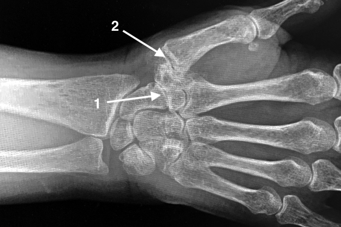 STT Osteoarthritis right wrist(1) with Thumb CMC Osteoarthritis (2).  This will require different treatment than isolated STT  Osteoarthritis.