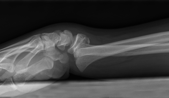 Salter II Fracture Distal Radius Lateral View