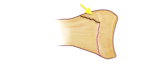 Salter II Fracture - Fracture line through growth plate (physis) and metaphysis. The metaphyseal fragment is called the Thurston-Holland fragment.