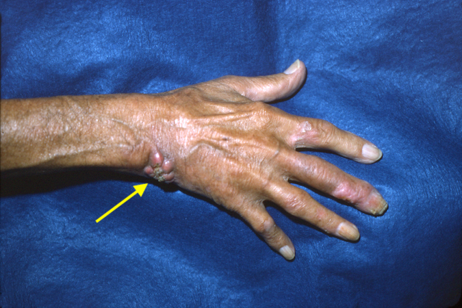 Squamous cell carcinoma (arrow) in a retired pediatrician who had been in the habit of holding his young patients while taking fluoroscopy images of their chest.
