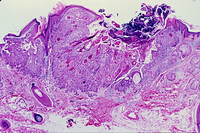 Squamous cell carcinoma pathologic specimen