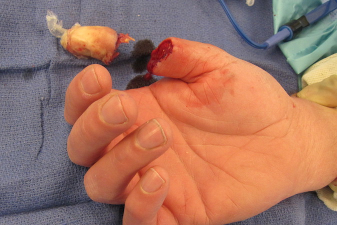 Intra-operative right thumb amputation for treatment of a subungual squamous cell carcinoma.