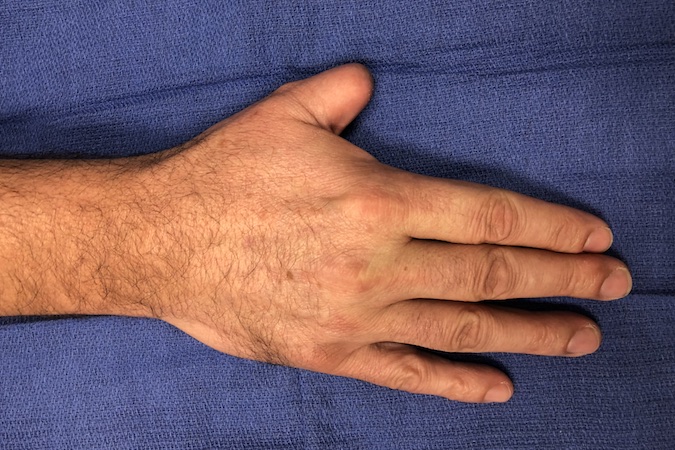 Post-operative photo right thumb 4 months after amputation for treatment of a subungual squamous cell carcinoma.