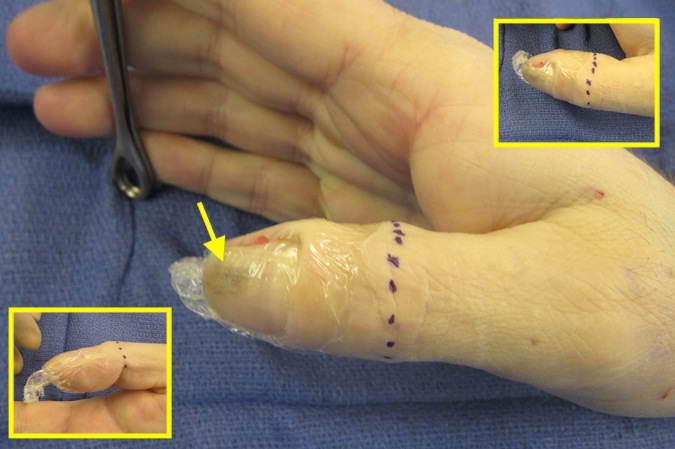 Plan for right thumb amputation for treatment of a subungual squamous cell carcinoma.  Note pigment changes at arrow.  Diagnosis made after an earlier nailed biopsy.