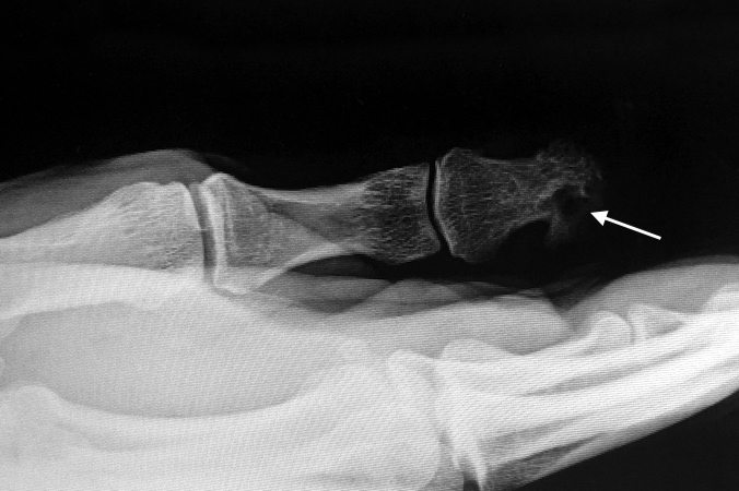 Squamous cell carcinoma AP X-ray of the thumb with bone involvement (arrow).