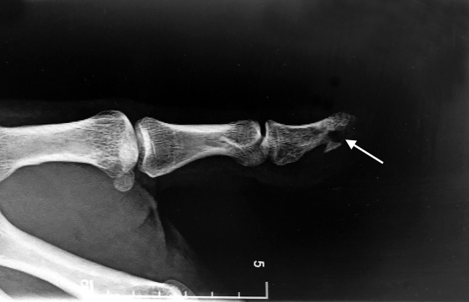 Squamous cell carcinoma lateral X-ray of the thumb with bone involvement (arrow).