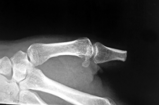 Post-operative X-ray of right thumb after amputation for treatment of a subungual squamous cell carcinoma.