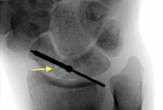 Screw being placed over guide wire for fixation of proximal scaphoid fracture