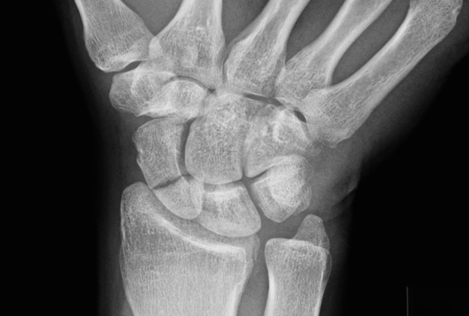 Mid 1/3 Proximal 1/3 Scaphoid Fracture with signs of proximal pole AVN