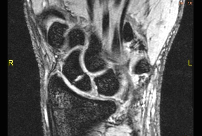 Non-displaced scaphoid fracture on MRI with no signs of AVN