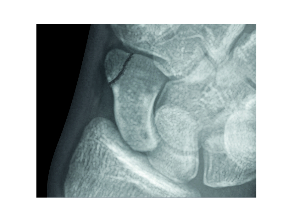 Scaphoid (Navicular) Fracture Distal Tuberosity Non-displaced