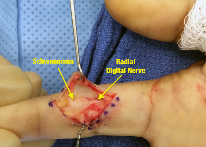Case 2 - Schwannoma radial digital nerve of the index finger