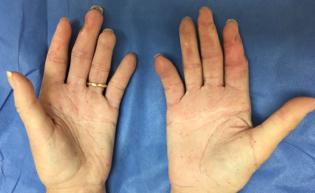 Chronic scleroderma bilateral hands.