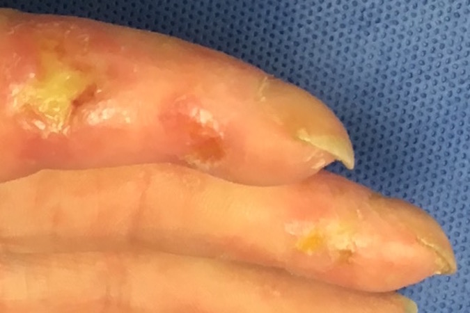 Chronic scleroderma skin changes and ulcers