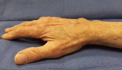 Dorsal wrist tenosynovitis