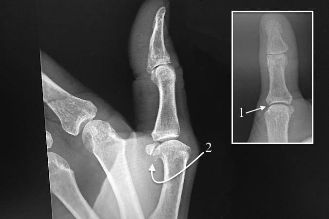 Patient complaining of thumb MP joint pain. No trigger thumb or significant MP OA identified (1) but note osteophytes and sclerosis (2) in the sesamoid metacarpal head joint.