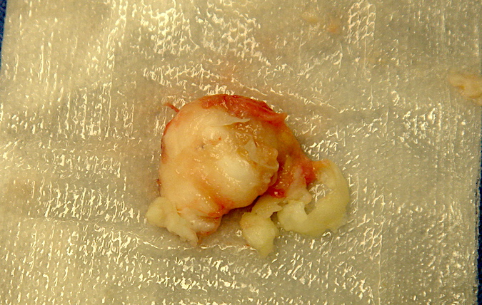 Surgical specimen ready for submission to pathology. Note the keratin material.