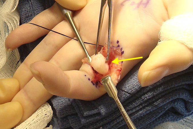 Excised cyst in clamp. Note the cyst is a soft compressible (arrow).