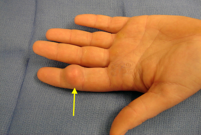 Left index finger painful sebaceous cyst (arrow) on the palmar aspect of the middle phalanx.