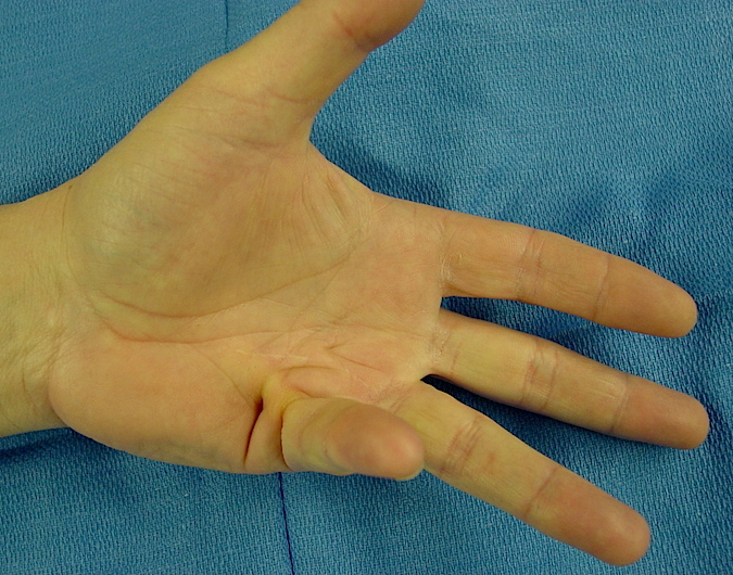 Dupuytren's Contracture fifth finger caused by classic central cord AP view