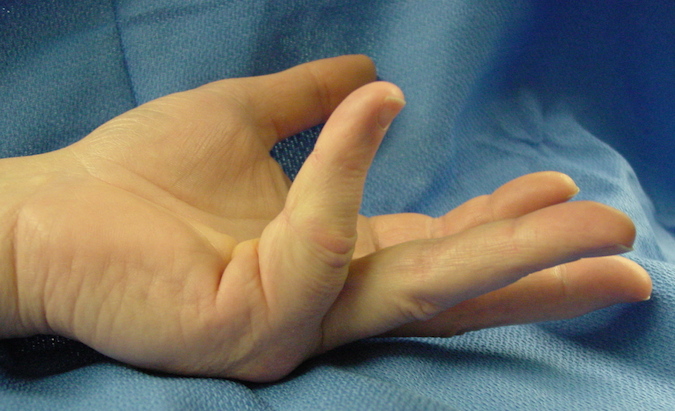 Dupuytren's Contracture fifth finger caused by classic central cord