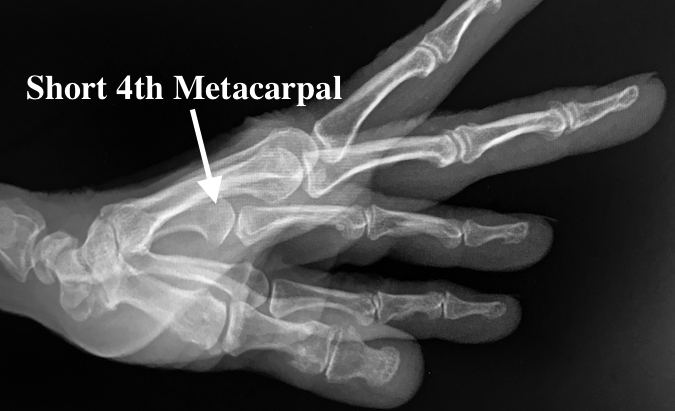 Brachydactyly - Lateral short 4th Metacarpal (arrow)