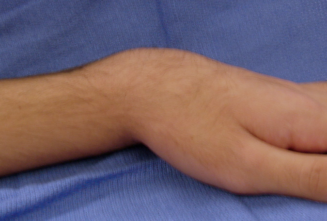 Silver Fork Deformity Secondary to Distal radius Fracture