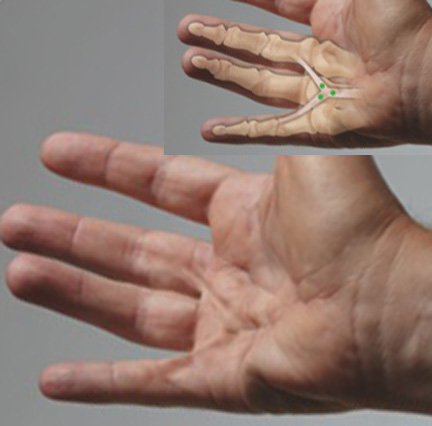 Central cord in palm proximal to ring finger and two natatory cords combining to form a "super Y" cord and contract the MP joints of two fingers on either side of the ring finger. Targets for collagenase in green.