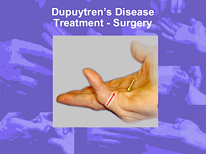 Surgical treatment of Dupuytren's Disease