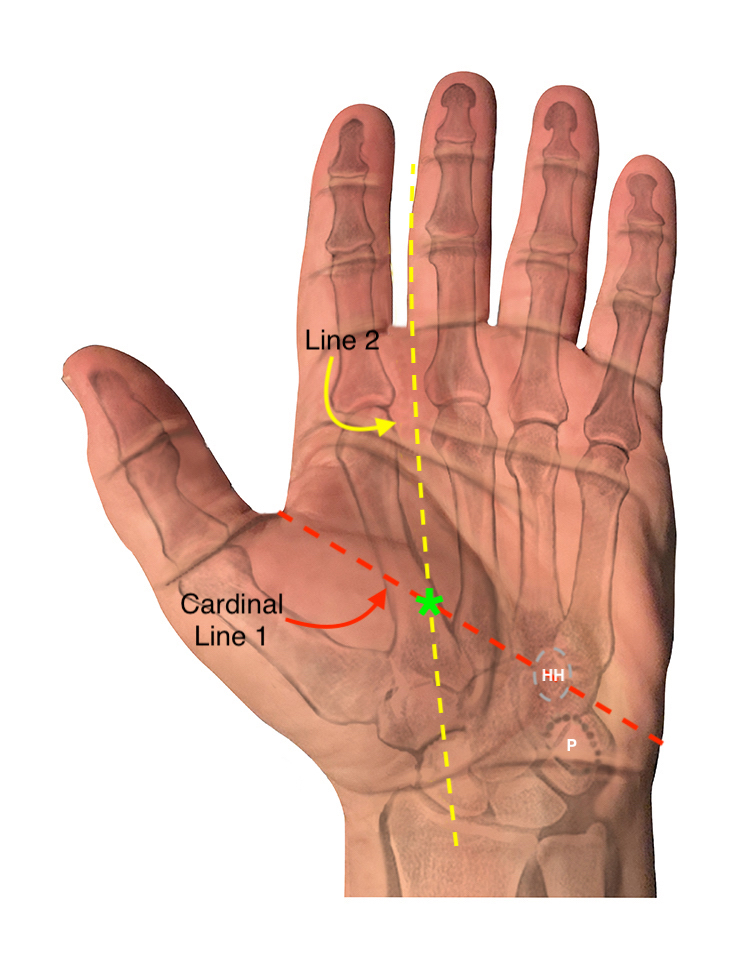 The second line is drawn parallel to the radial border of the long finger, it crosses the cardinal line at the point where the motor branch of the median nerve (*) enters the thenar muscles.  