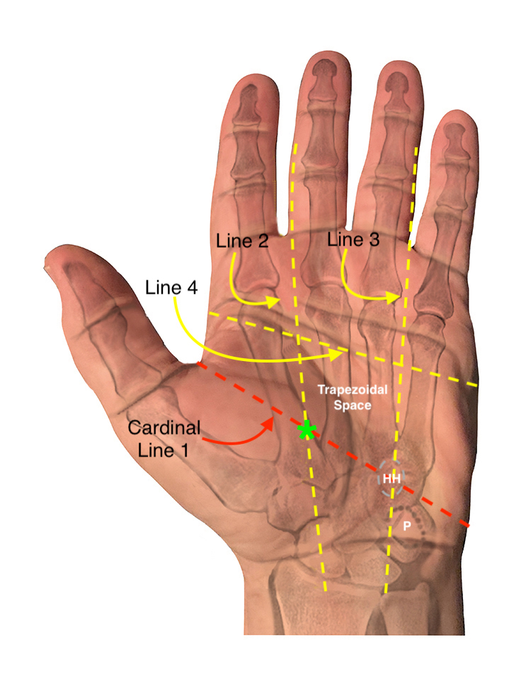 The fourth line is drawn from the radial edge of the proximal palmar crease [proximal to the base of the index finger] to the ulnar edge of the distal palmar crease [proximal to the base of the little finger].
