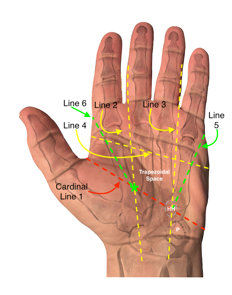 The fifth line from the ulnar side of the fifth finger to the hook of the hamate defines the path of the ulnar sensory distal nerve of the fifth finger. The sixth line from the radial side of the index finger to the point of origin of the median motor nerve defines the path of the radial sensory digital nerve of the index finger.