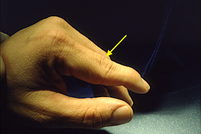 Swan neck deformity of the left index finger.  Note the dorsally displaced lateral bands (arrow)
