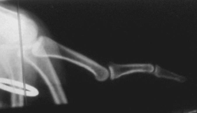 X-ray of swan neck deformity of the left index finger.  Note absence of arthritic changes in the PIP and DIP joints
