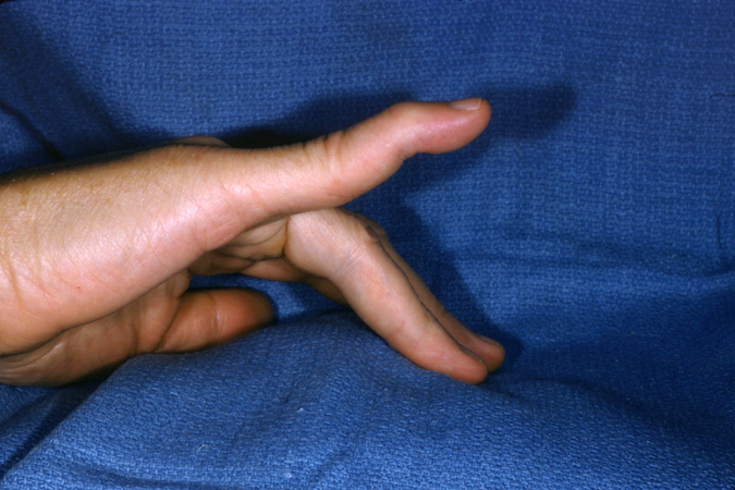 Swan neck deformity of the right little finger secondary to a chronic mallet finger injury.