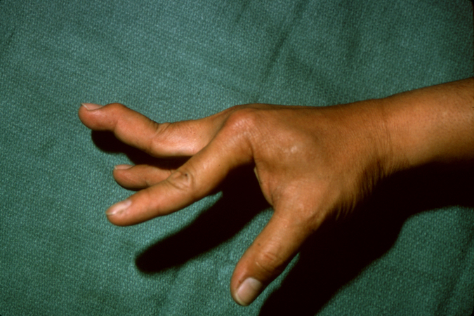 Swan neck deformity of the right index finger secondary to a chronic volar plate injury