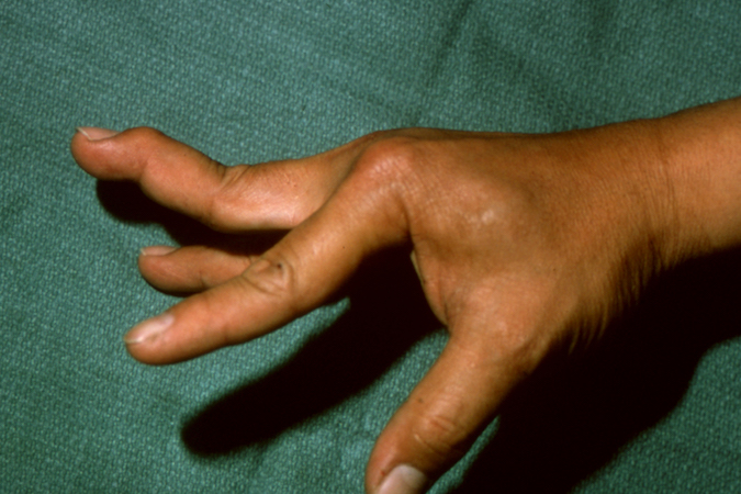 Swan neck deformity secondary to chronic volar plate rupture right long finger PIP joint