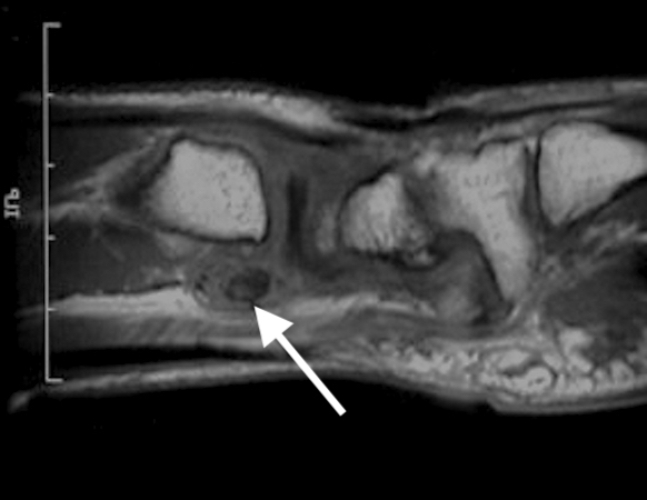 Lateral MRI of Synovial Chondromatosis of right DRUJ (arrow).