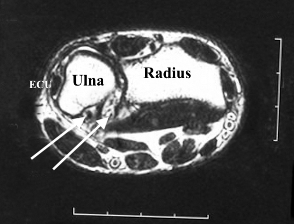 MRI of Synovial Chondromatosis of right volar DRUJ (arrows).