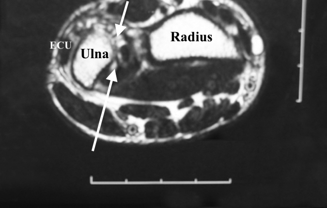 MRI of Synovial Chondromatosis of right DRUJ (arrows).