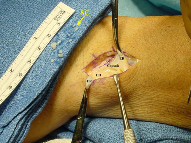  Distal radioulnar joint arthrotomy to remove synovial chondromas (SC) from joint. Extensor retinaculum (ER); DRUJ capsule and Ulnar head (UH) labeled.