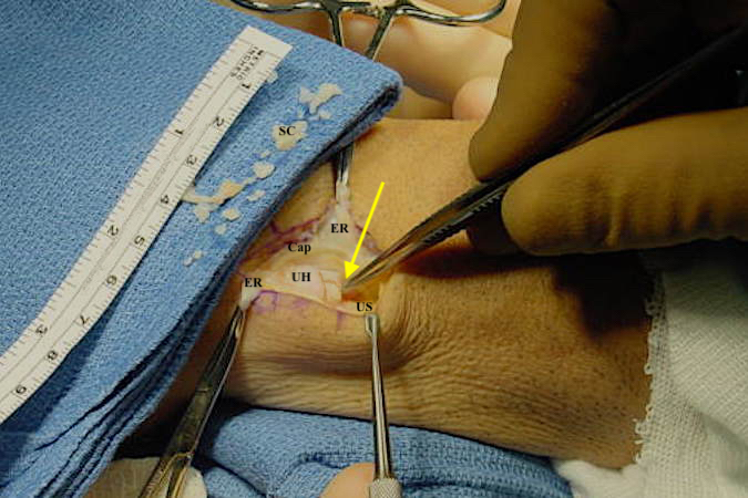 Distal radioulnar joint arthrotomy (deeper view) to remove synovial chondromas (SC) from joint. Extensor retinaculum (ER); DRUJ capsule (Cap); Ulnar head (UH) and chondromas (arrow) labeled.