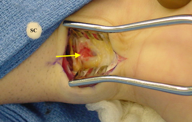 Distal radioulnar joint arthrotomy volar approach to remove synovial chondroma (SC).